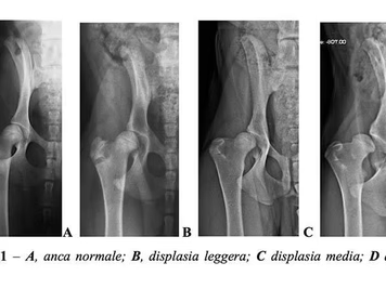 Displasia dell'Anca